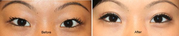 double eyelid before and after