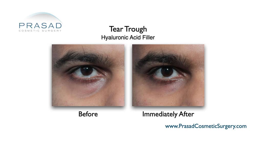 Tear Trough Filler Before and After Photos | Puffy Eyes New York