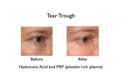 tear trough under eye filler before and after