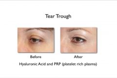 before and after tear trough fillers