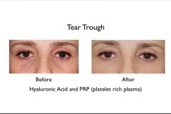 tear trough filler results before and after