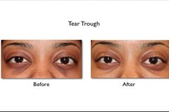 hyaluronic acid filler for tear trough before and after