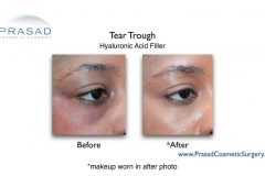 before and after tear trough filler