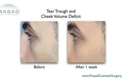 tear trough filler before and after men