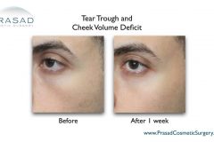 tear trough and cheek filler before and after