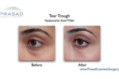 filler in tear trough before and after