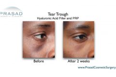 tear trough filler before and after photos