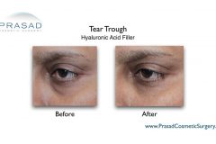 eye trough filler before and after