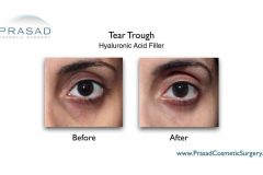 dermal fillers for tear trough before and after