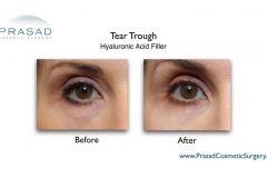 eye fillers before and after