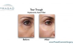 eye filler for eye bag and hollow eyes before and after