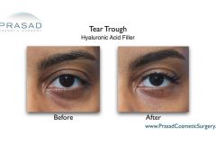 trough fillers before and after