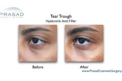 eye filler for tear trough and eye bags before and after