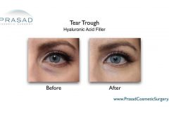 under-eye-filler-left-eye-face-forward-performed-by-Dr-Amiya-Prasad