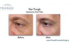 tear trough eye filler for male before and after