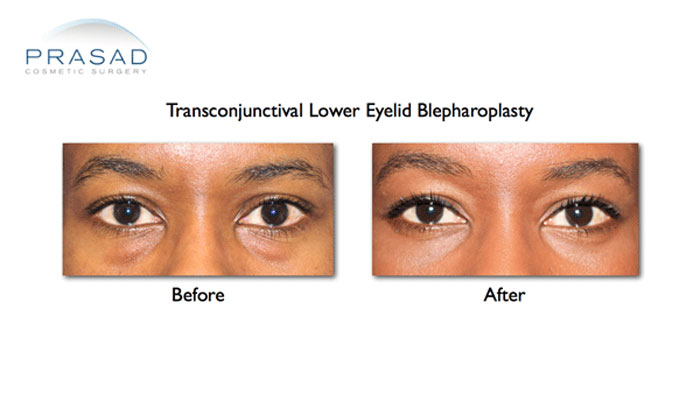 Asian Eyelid Surgery Cost Kochi  Double Eyelid Surgery Kerala