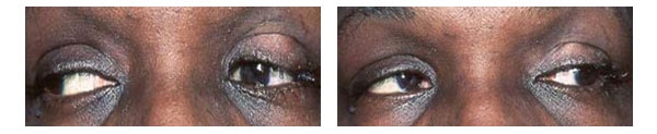 Artificial Eye before and after implant