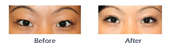 Asian blepharoplasty before and after