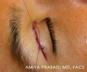 Asian Eyelid Plastic Surgery