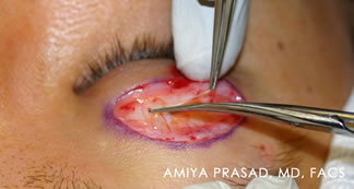 Asian Eyelid Plastic Surgery