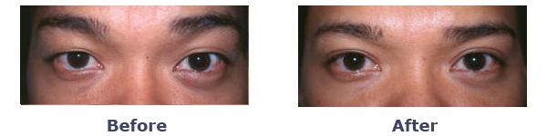 east asian blepharoplasty for men before and after