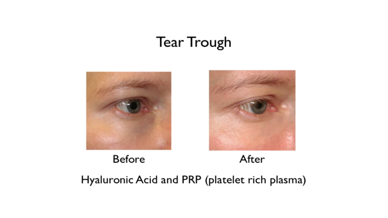 Regenerative Treatment for Under Eye Wrinkles and Bags