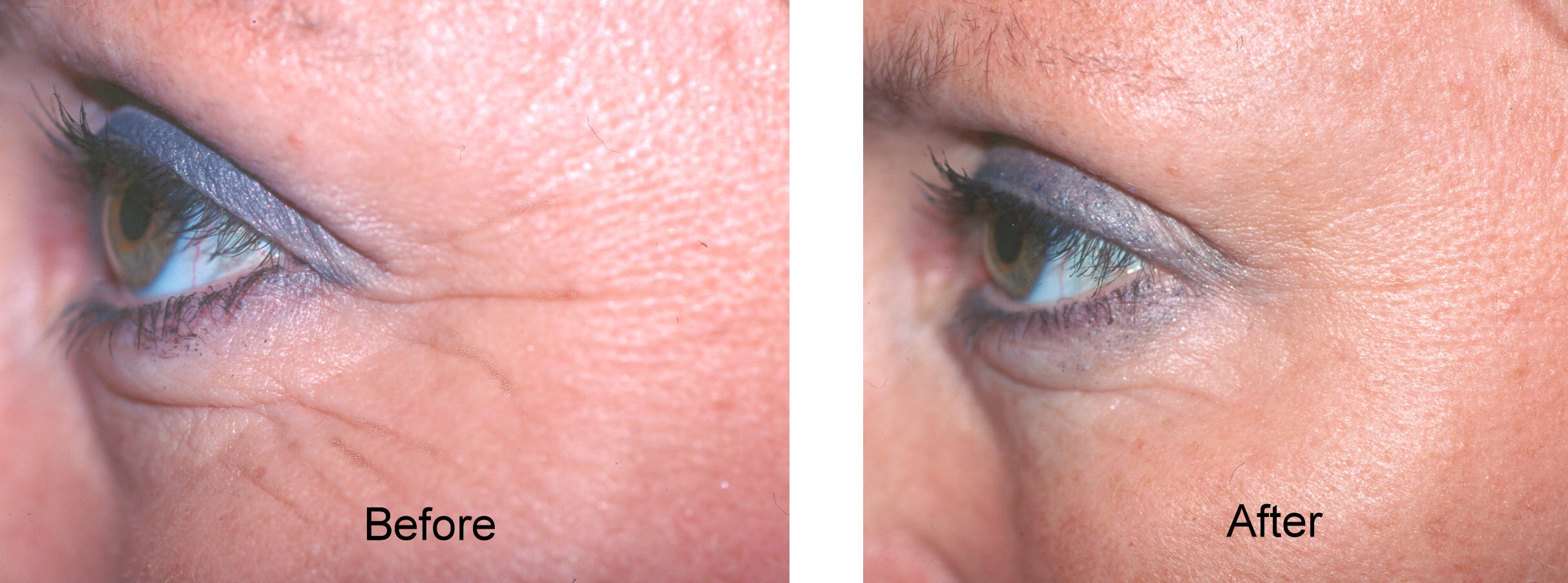 before and after Botox and Dysport treatment for crow's feet