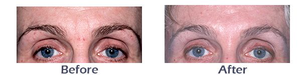 Botox treatment before and after