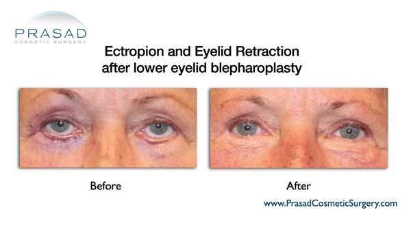 Lower eyelid retraction and ectropion after eye bags surgery before and after repair 