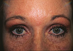 after upper eyelid surgery