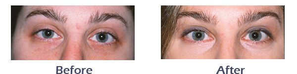 Laser Skin Resurfacing Before and After