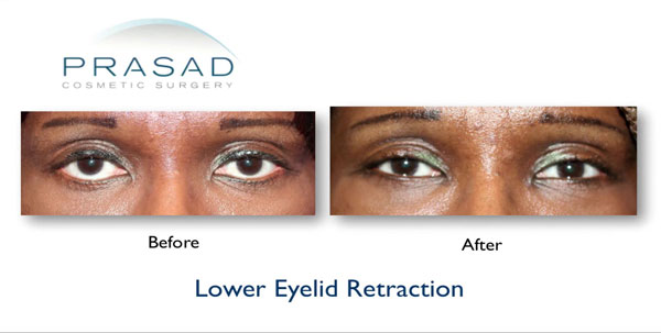 before and after lower eyelid retraction female patient