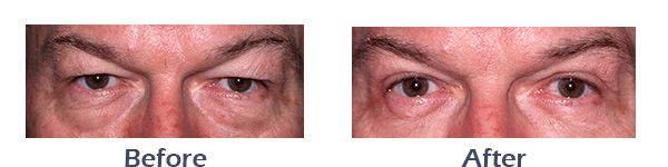 Male Eyelid Surgery Before and After