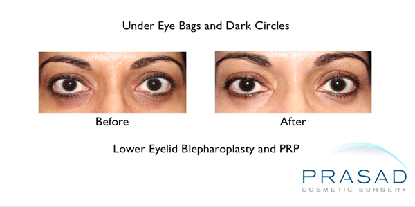 under eye bags and dark circles treatment before and after
