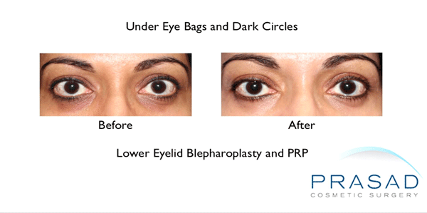 Under Eye Hollows and Dark Circles Treatment