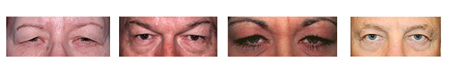 different people 1 common problem - sagging or drooping eyelids