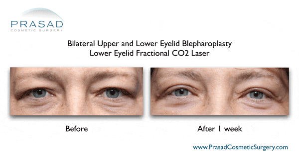 before and after upper and lower eyelid blepharoplasty