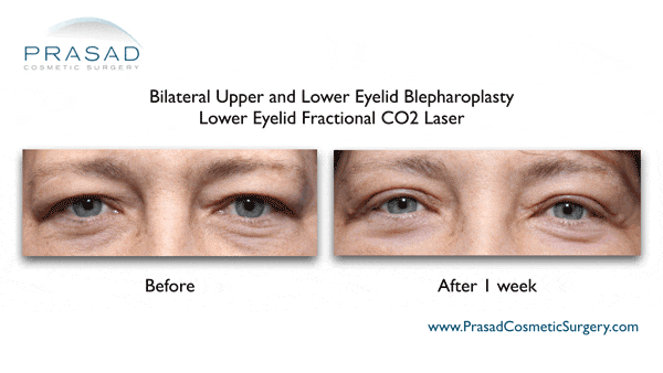 Under Eye Filler Before and After Photos - Prasad Cosmetic Surgery NY