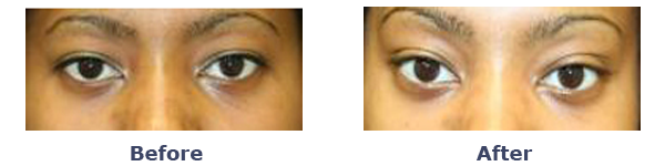 before and after almond eye shape surgery