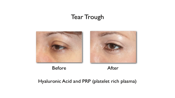 hollow under eyes and tear troughs treatment before and after