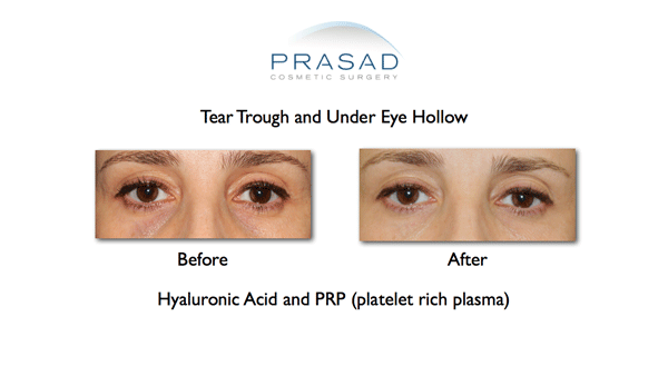 Under eye hollows before and after