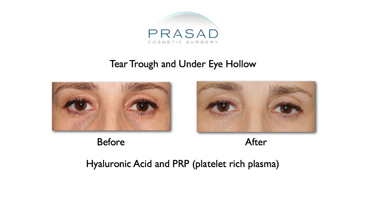 Under Eye Hollows and Dark Circles Treatment