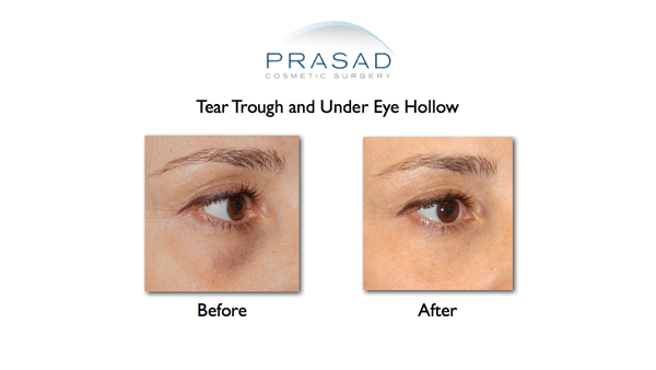 hollow under eyes and dark circles treatment before and after