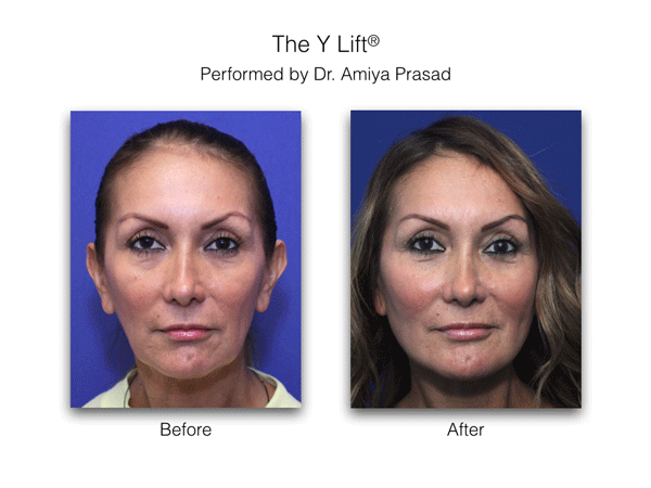 Juvederm Under Eyes NYC, Injectable Fillers Under Eyes