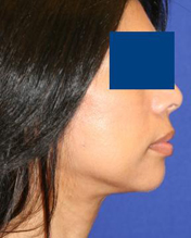  after Facelift Surgery - patient left side view