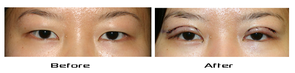 Photo Immediately After Asian Eye Surgery