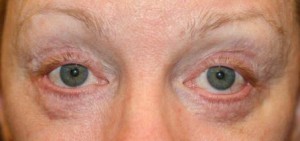 bad eyelid surgery picture - woman with eyelid surgery complication