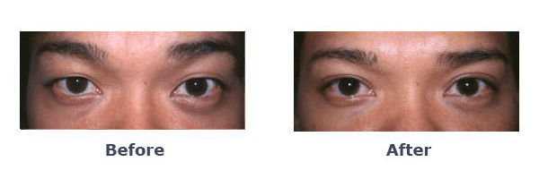Double eyelid surgery before and after male
