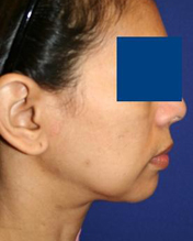 Before Facelift Surgery - patient left side view