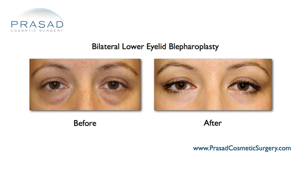 eye bag surgery recovery before and after